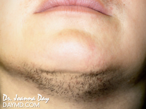 Laser Hair Removal - Before After Photos - Facial Hair (Female Chin)