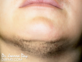 Chin Hair Facts Why They Grow And How To Get Rid Of Them For Good   Glamour UK